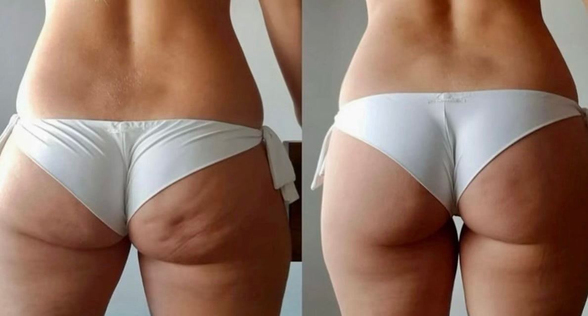 Appareil Anti-Cellulite